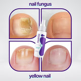 Jaysuin - Nail Fungus Spray (Original)